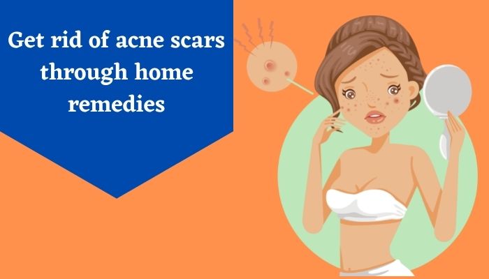 Get rid of acne scars through home remedies
