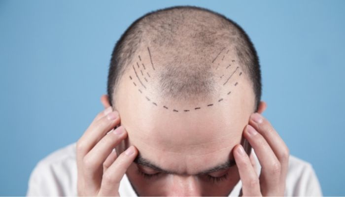 What is the Cost of Hair Transplant in India